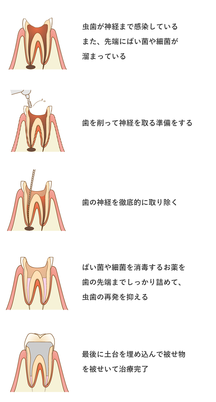 歯根治療の流れ